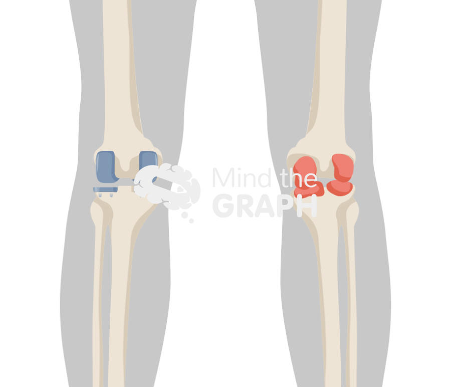 Bicondylar knee arthroplasty anterior posterior body Icons, Symbols, Pictures, and Images