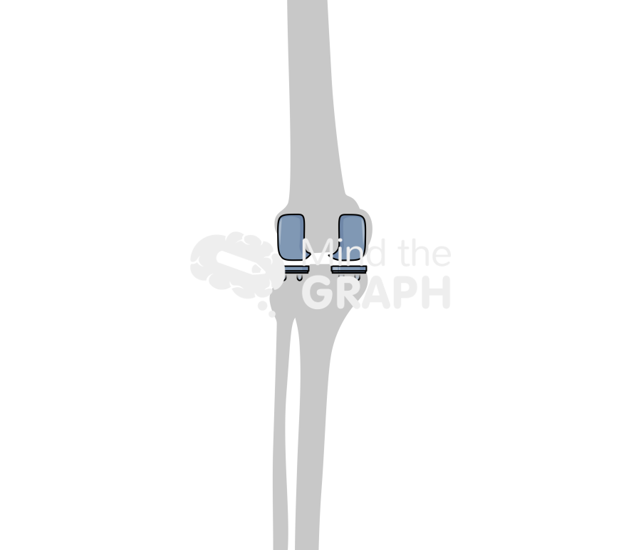 Bicondylar knee arthroplasty anterior posterior bone Icons, Symbols, Pictures, and Images