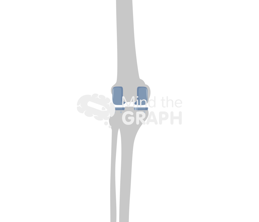 Bicondylar knee arthroplasty anterior posterior bone Icons, Symbols, Pictures, and Images