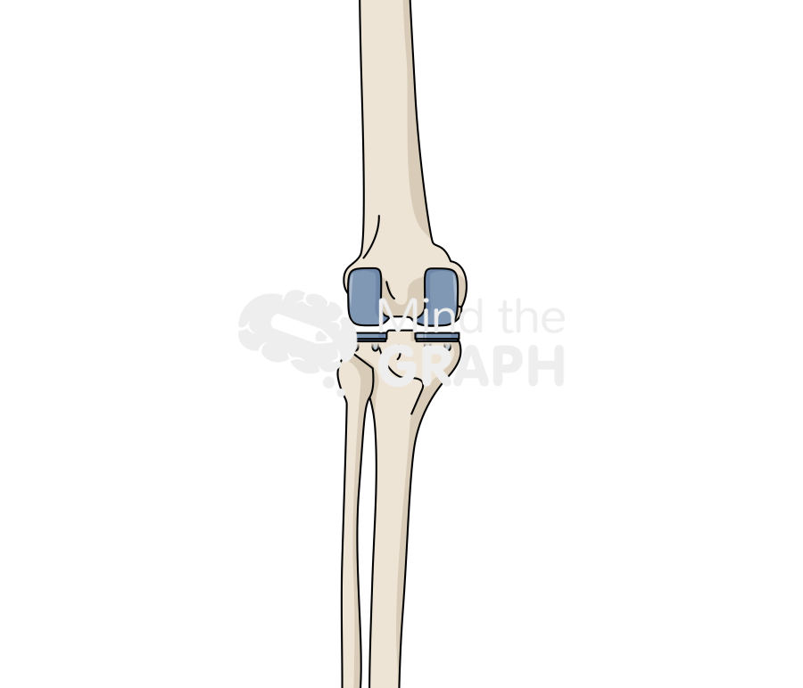Bicondylar knee arthroplasty anterior posterior bone full Icons, Symbols, Pictures, and Images