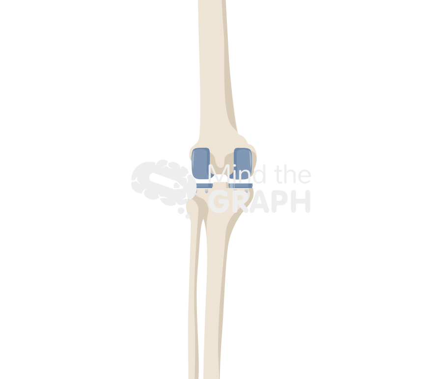 Bicondylar knee arthroplasty anterior posterior bone full Icons, Symbols, Pictures, and Images