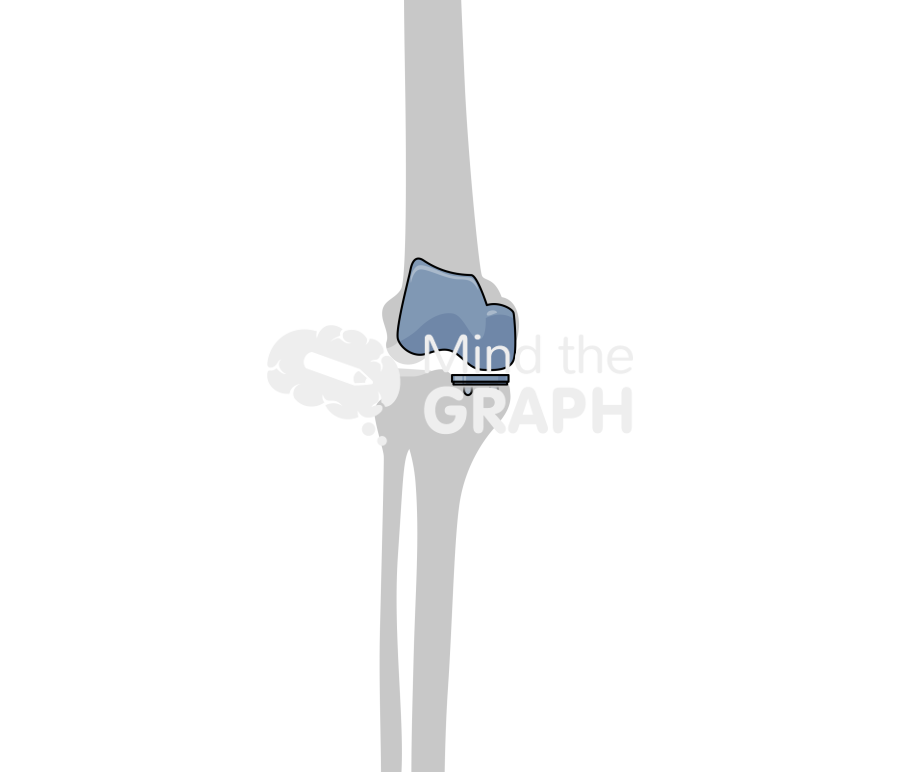 Bicondylar knee arthroplasty bone Icons, Symbols, Pictures, and Images