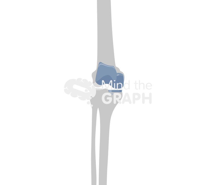 Bicondylar knee arthroplasty bone Icons, Symbols, Pictures, and Images