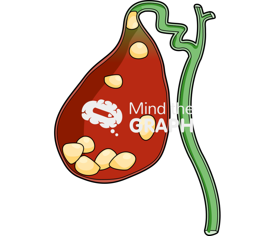Big calculi biliary cholecystitis Icons, Symbols, Pictures, and Images