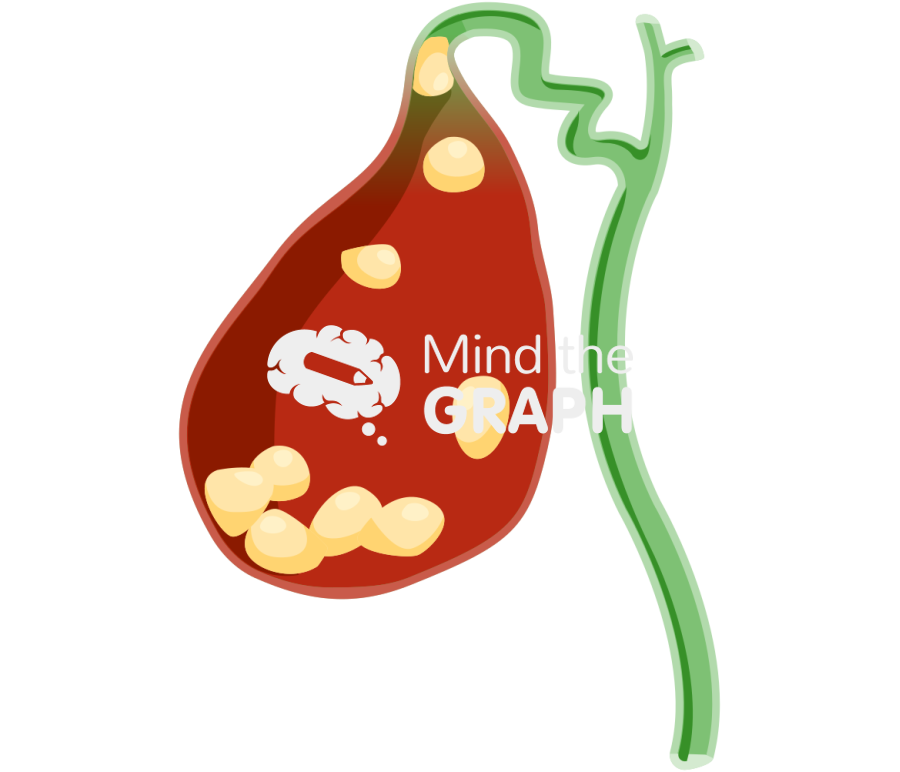 Big calculi biliary cholecystitis Icons, Symbols, Pictures, and Images