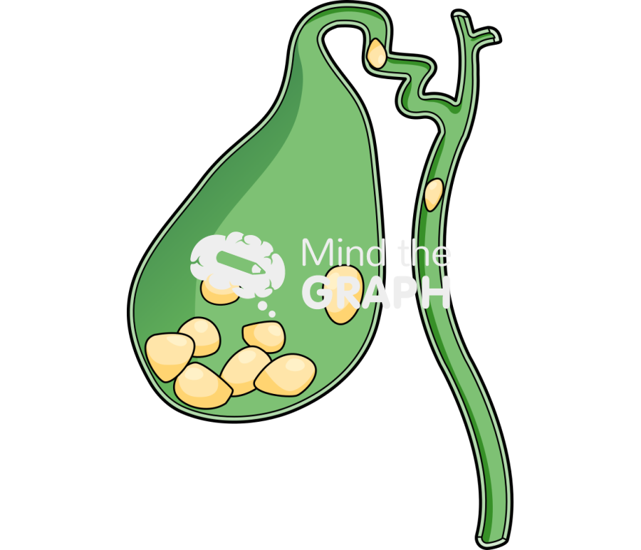 Big calculi biliary lithiasis Icons, Symbols, Pictures, and Images