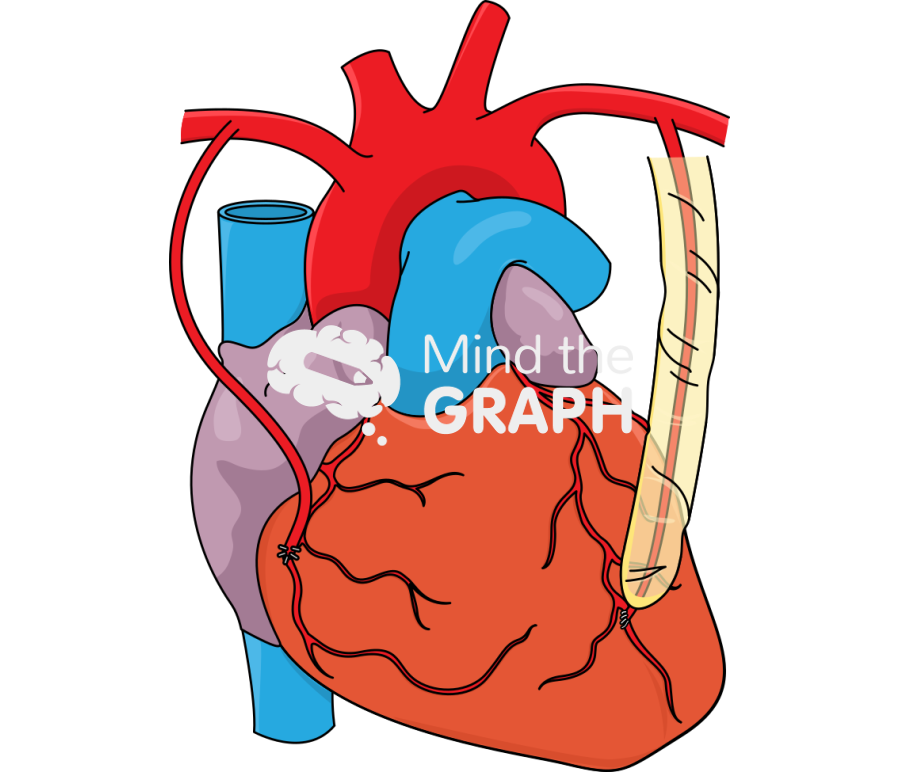 Bilateral internal mammary artery grafts coronary bypass Icons, Symbols, Pictures, and Images