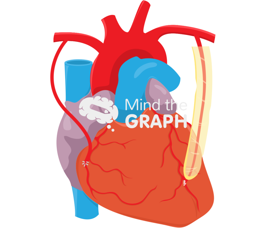 Bilateral internal mammary artery grafts coronary bypass Icons, Symbols, Pictures, and Images