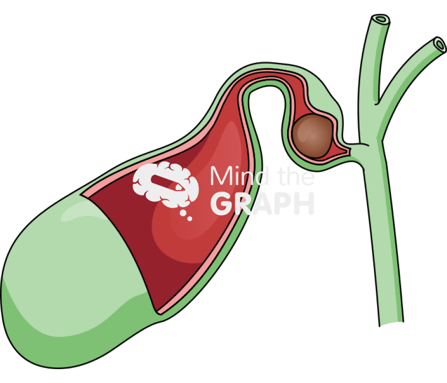 Biliary vesicle gallbladder mirizzi type 1 Icons, Symbols, Pictures, and Images