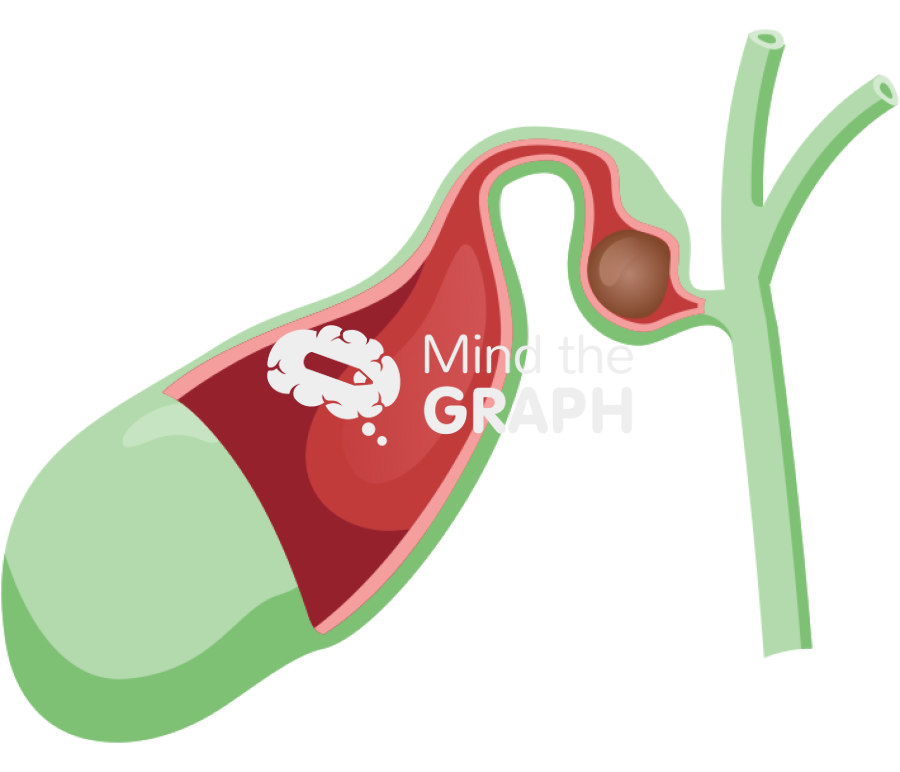 Biliary vesicle gallbladder mirizzi type 1 Icons, Symbols, Pictures, and Images