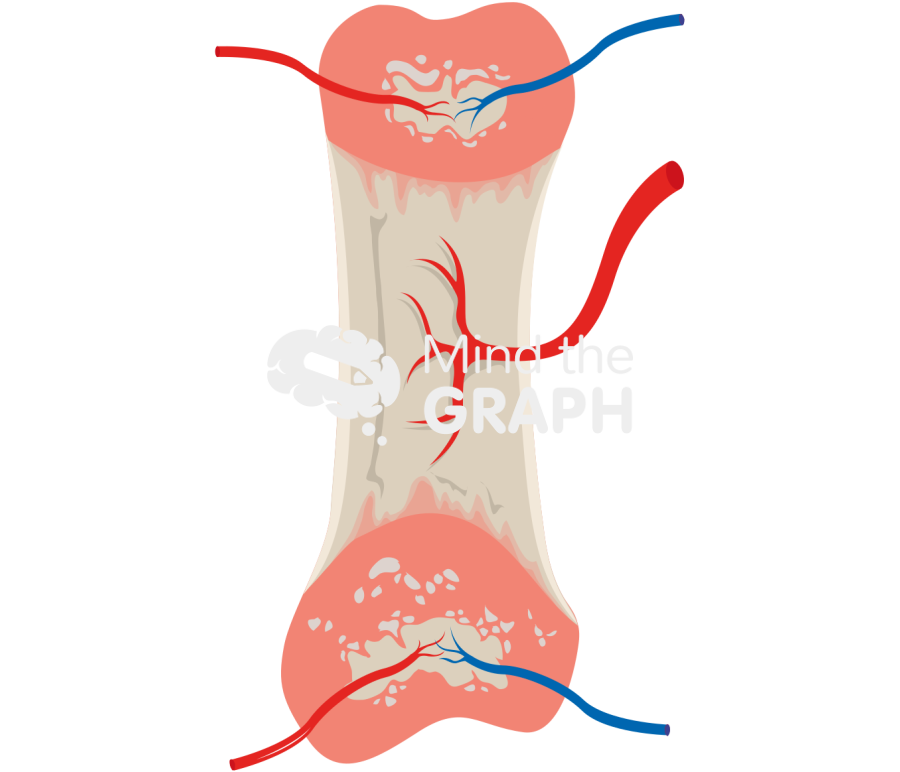 Bone growth 3 Icons, Symbols, Pictures, and Images