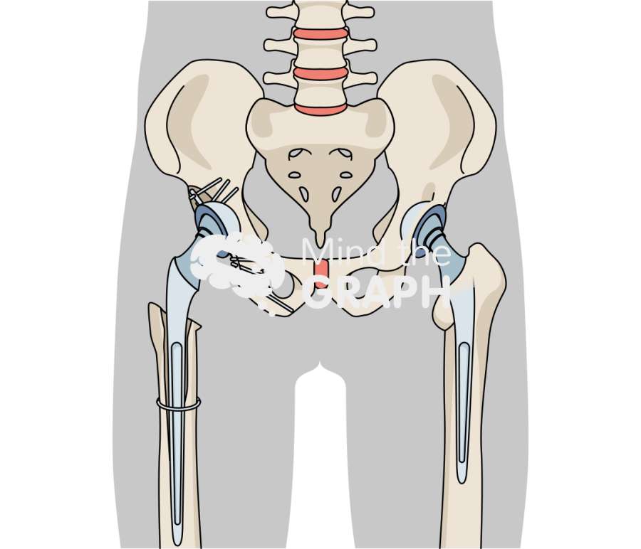 Bone loss total hip replacement body Icons, Symbols, Pictures, and Images