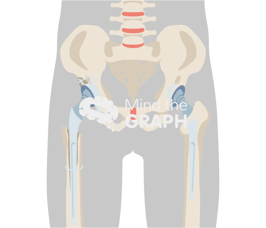 Bone loss total hip replacement body Icons, Symbols, Pictures, and Images