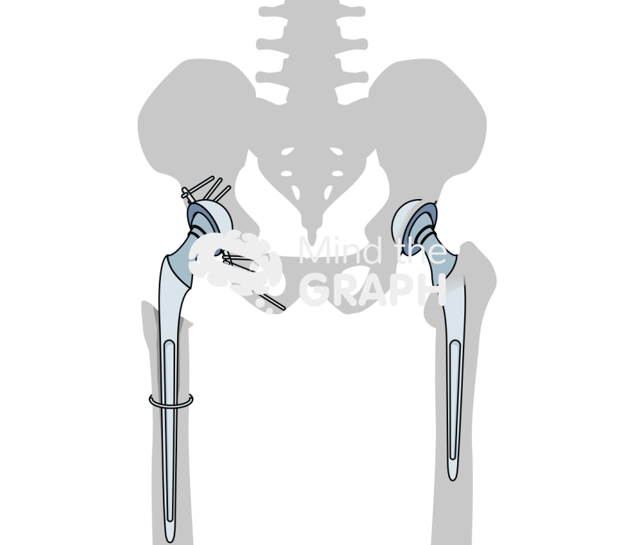 Bone loss total hip replacement bone Icons, Symbols, Pictures, and Images