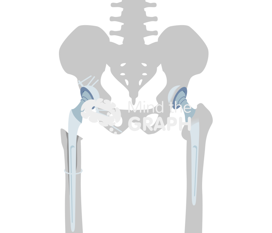 Bone loss total hip replacement bone Icons, Symbols, Pictures, and Images
