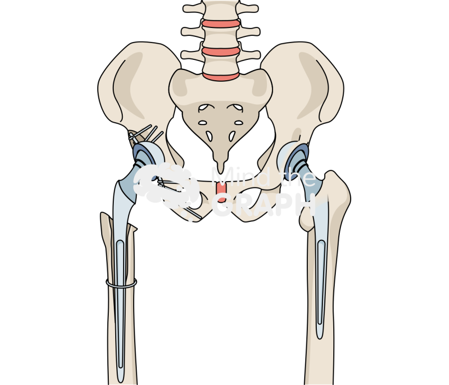 Bone loss total hip replacement bone full Icons, Symbols, Pictures, and Images