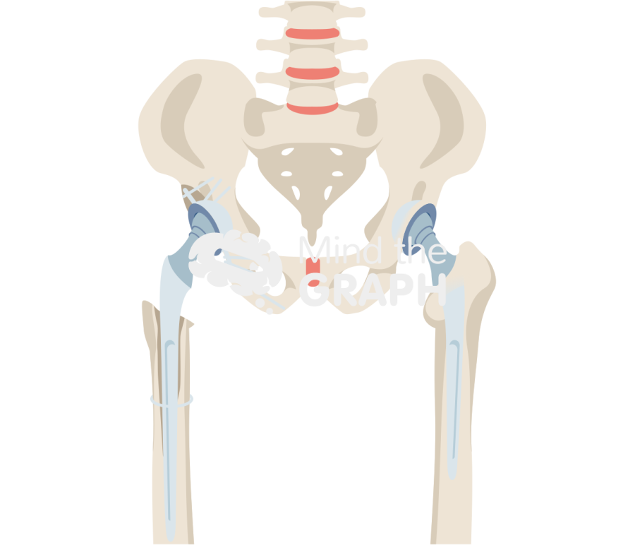 Bone loss total hip replacement bone full Icons, Symbols, Pictures, and Images