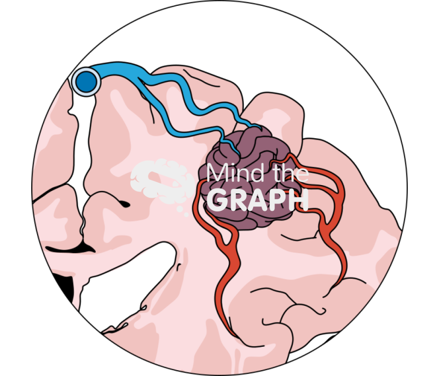 Brain arteriovenous malformation zoom Icons, Symbols, Pictures, and Images