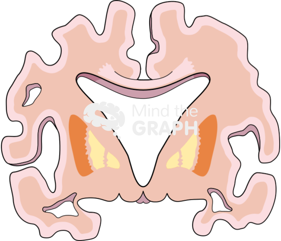 Brain cut alzheimer severe disease Icons, Symbols, Pictures, and Images