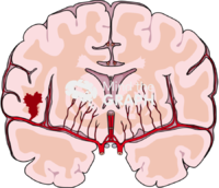 Brain cut hemorrhagic stroke Icons, Symbols, Pictures, and Images
