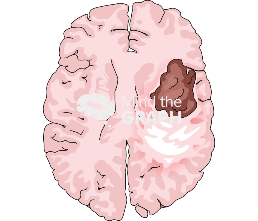 Brain glioblastoma t2 perilesional edema Icons, Symbols, Pictures, and Images