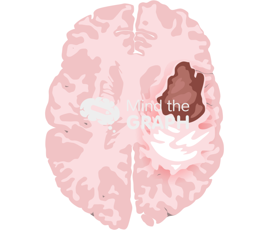 Brain glioblastoma t2 perilesional edema Icons, Symbols, Pictures, and Images