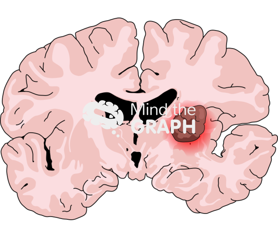 Brain glioma front cut Icons, Symbols, Pictures, and Images