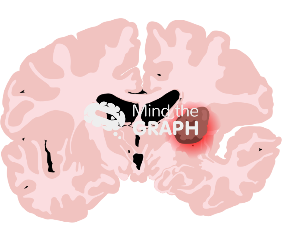 Brain glioma front cut Icons, Symbols, Pictures, and Images