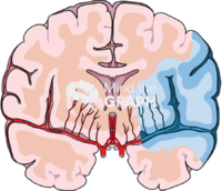 Brain ischemic stroke Icons, Symbols, Pictures, and Images