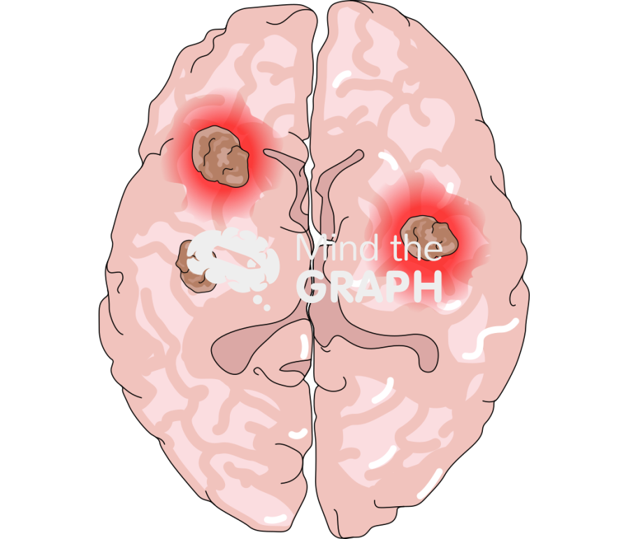 Brain metastasis with hemorrhage Icons, Symbols, Pictures, and Images