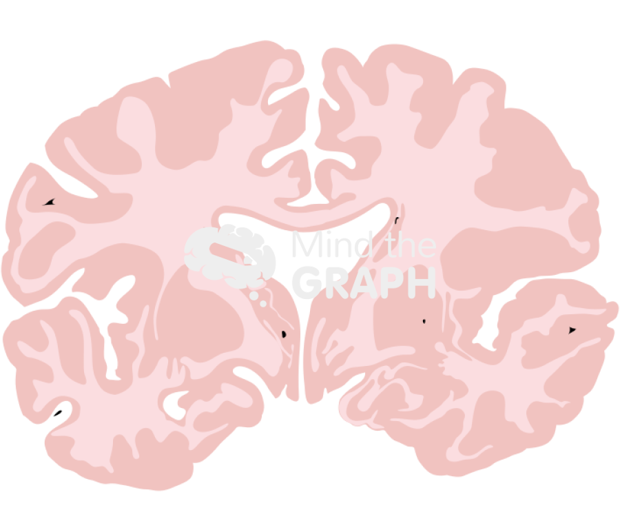 Brain mild alzheimer disease front cut Icons, Symbols, Pictures, and Images