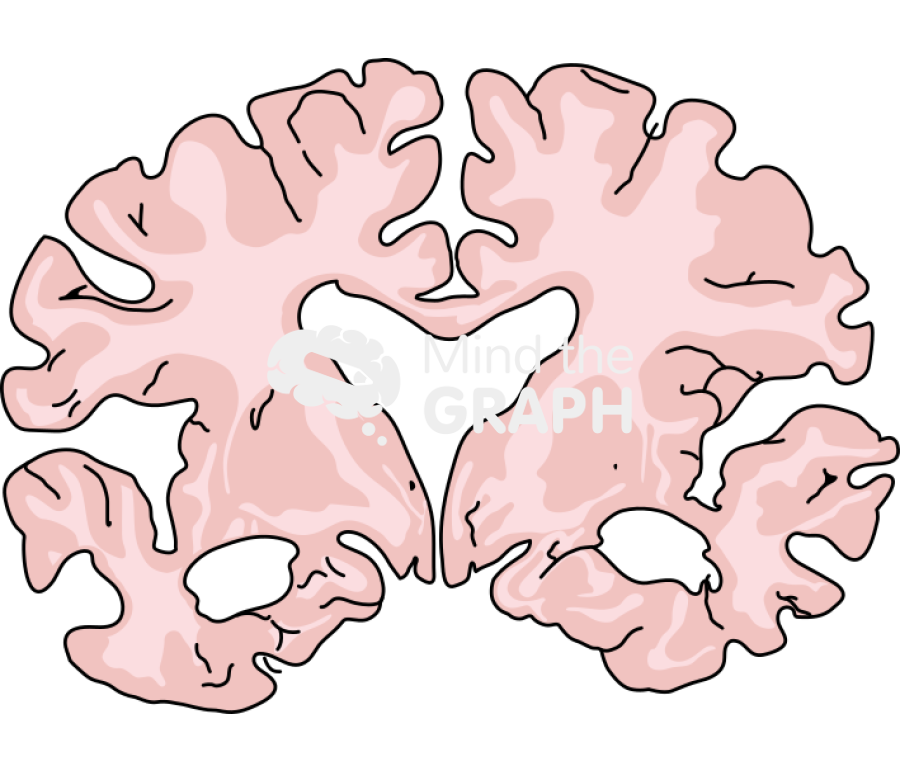 Brain severe alzheimer disease front cut Icons, Symbols, Pictures, and Images