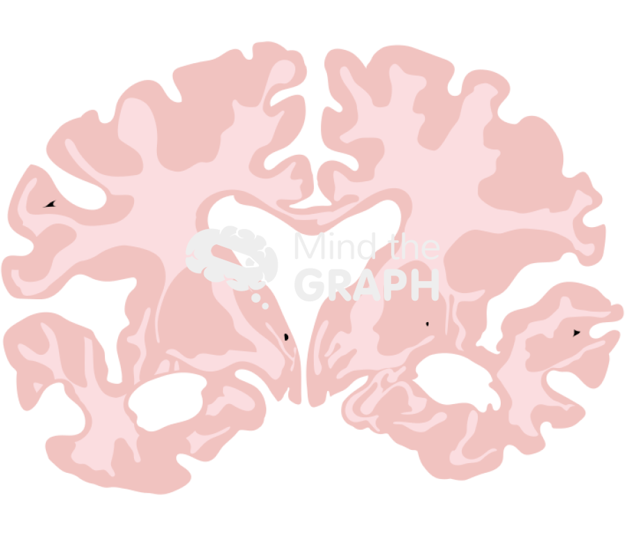 Brain severe alzheimer disease front cut Icons, Symbols, Pictures, and Images