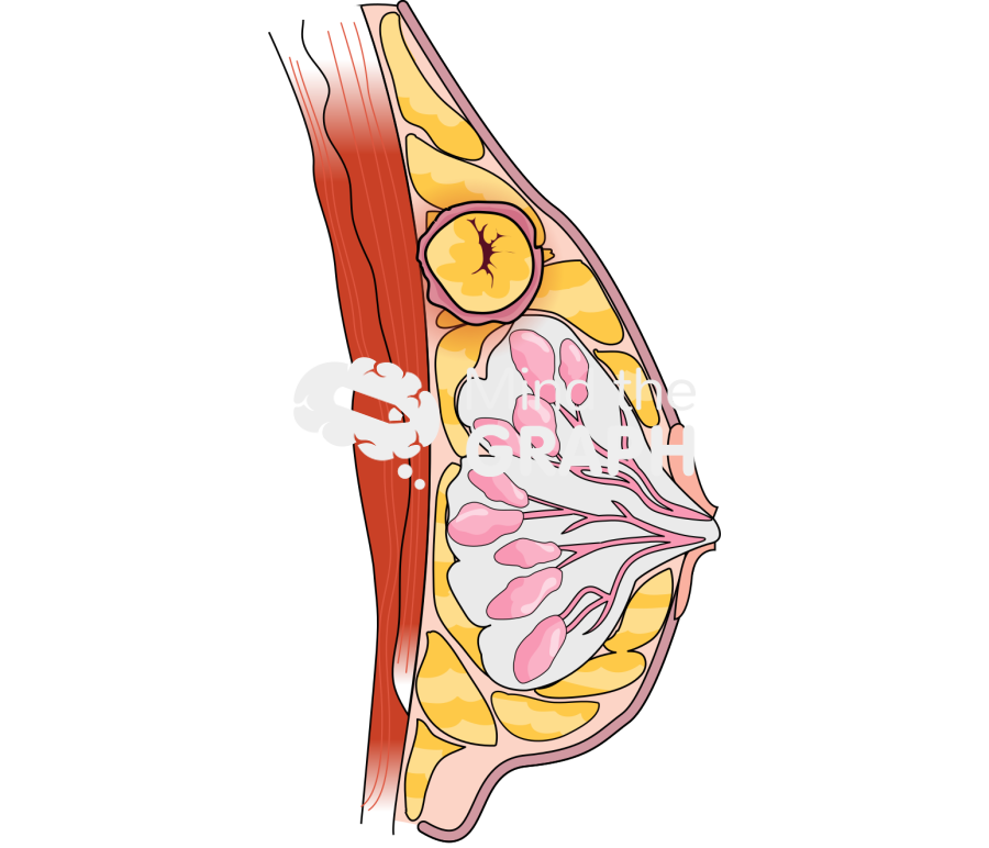 Breast cancer 3 Icons, Symbols, Pictures, and Images