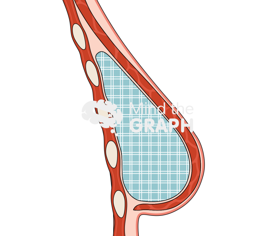 Breast tissue fat regeneration cut 1 Icons, Symbols, Pictures, and Images