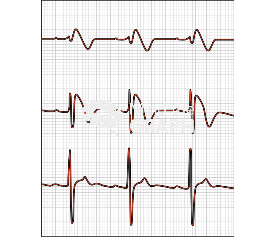 Brugada syndrome electrocardiogram Icons, Symbols, Pictures, and Images