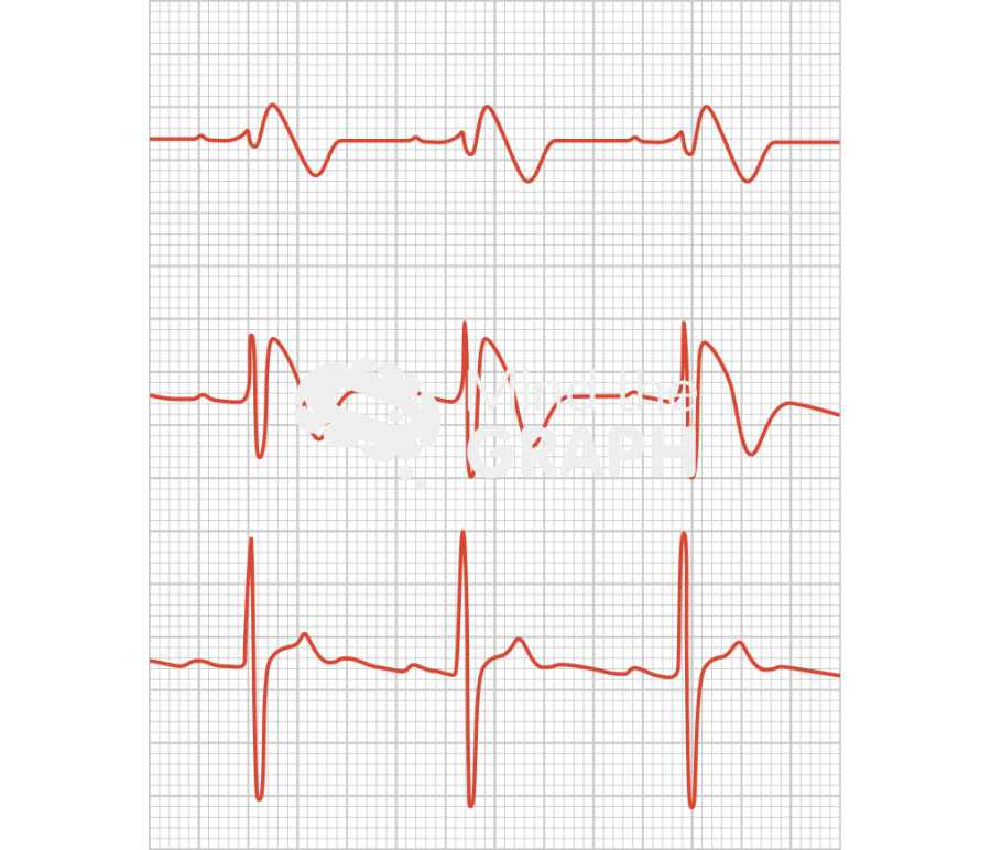 Brugada syndrome electrocardiogram Icons, Symbols, Pictures, and Images