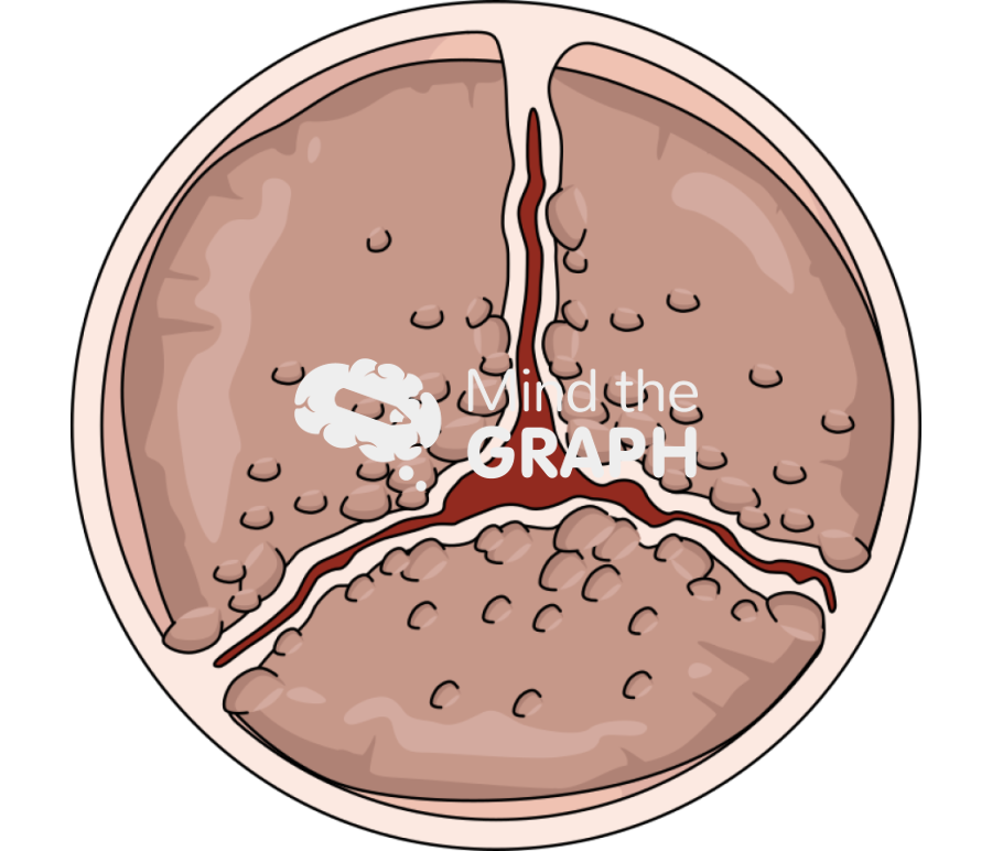 Calcific aortic valve disease zoom Icons, Symbols, Pictures, and Images