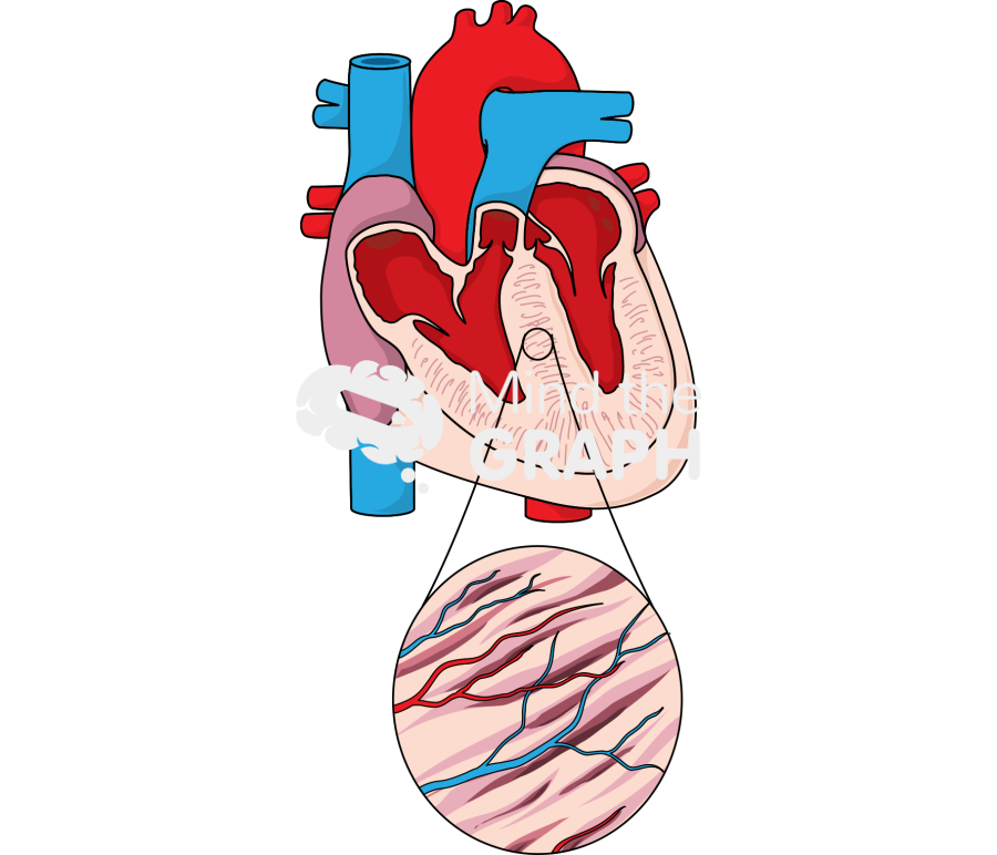 Cardiac hypertrophy Icons, Symbols, Pictures, and Images