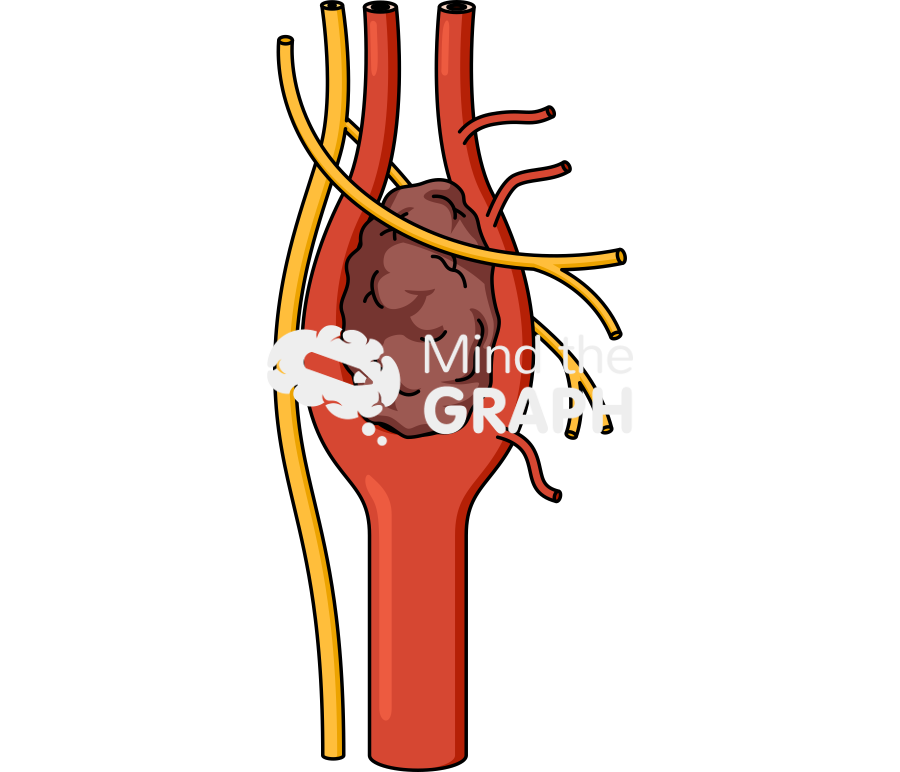 Carotid body tumor type 1 Icons, Symbols, Pictures, and Images