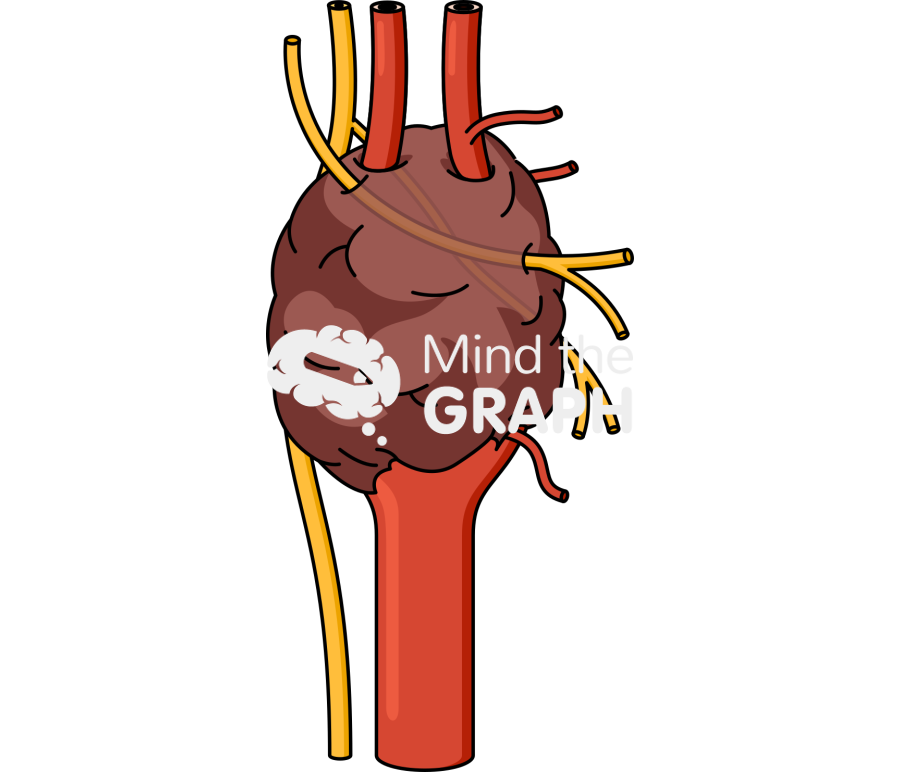 Carotid body tumor type 3 Icons, Symbols, Pictures, and Images
