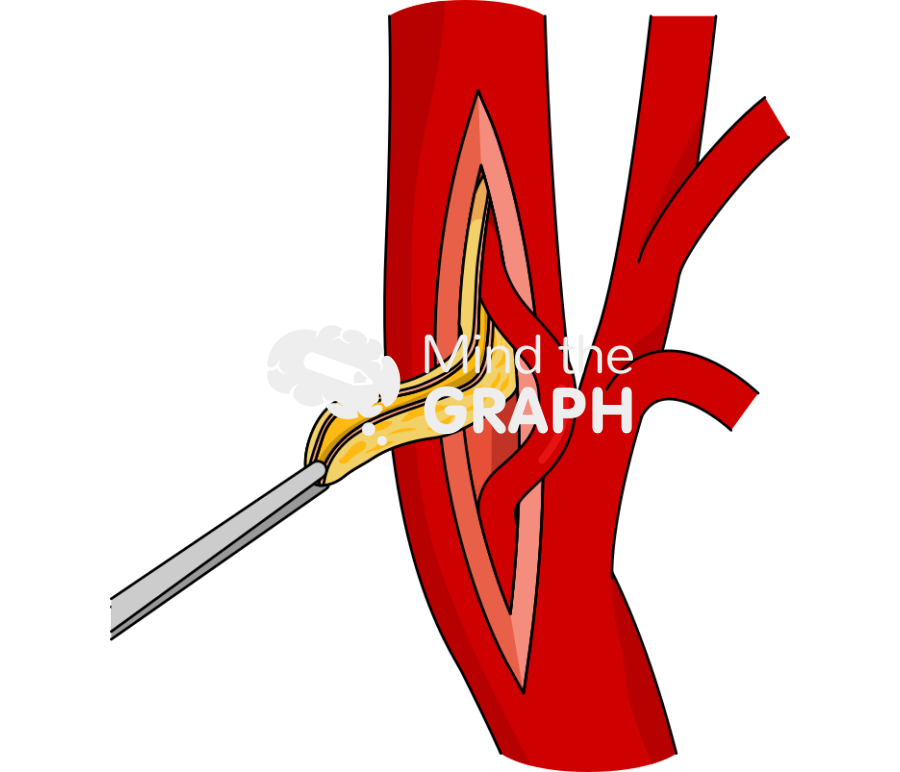 Carotid endarterectomy Icons, Symbols, Pictures, and Images