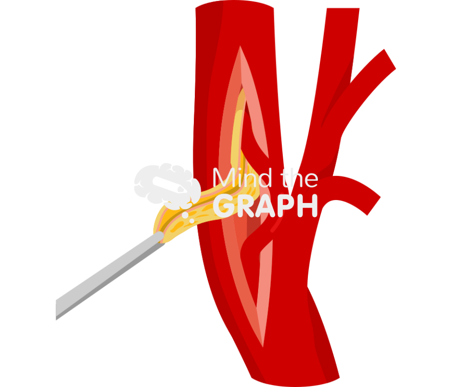 Carotid endarterectomy Icons, Symbols, Pictures, and Images