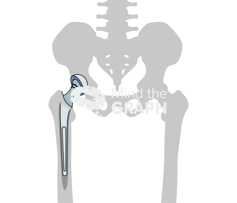 Cemented total hip arthroplasty bone Icons, Symbols, Pictures, and Images