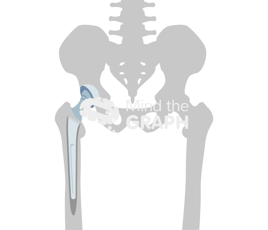 Cemented total hip arthroplasty bone Icons, Symbols, Pictures, and Images