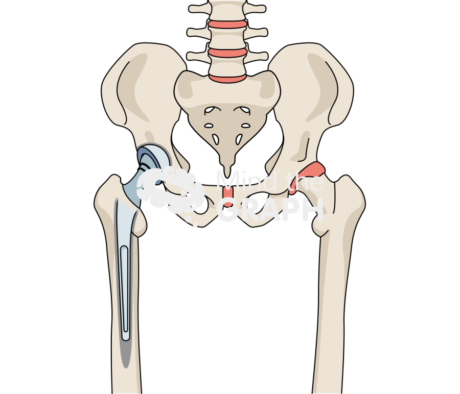 Cemented total hip arthroplasty bone full Icons, Symbols, Pictures, and Images