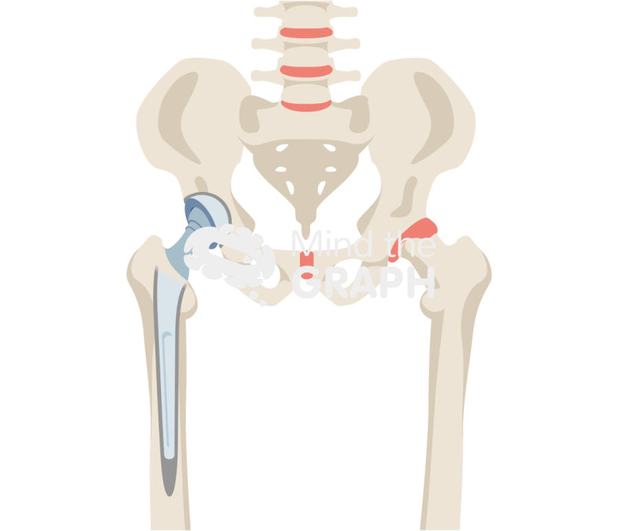 Cemented total hip arthroplasty bone full Icons, Symbols, Pictures, and Images