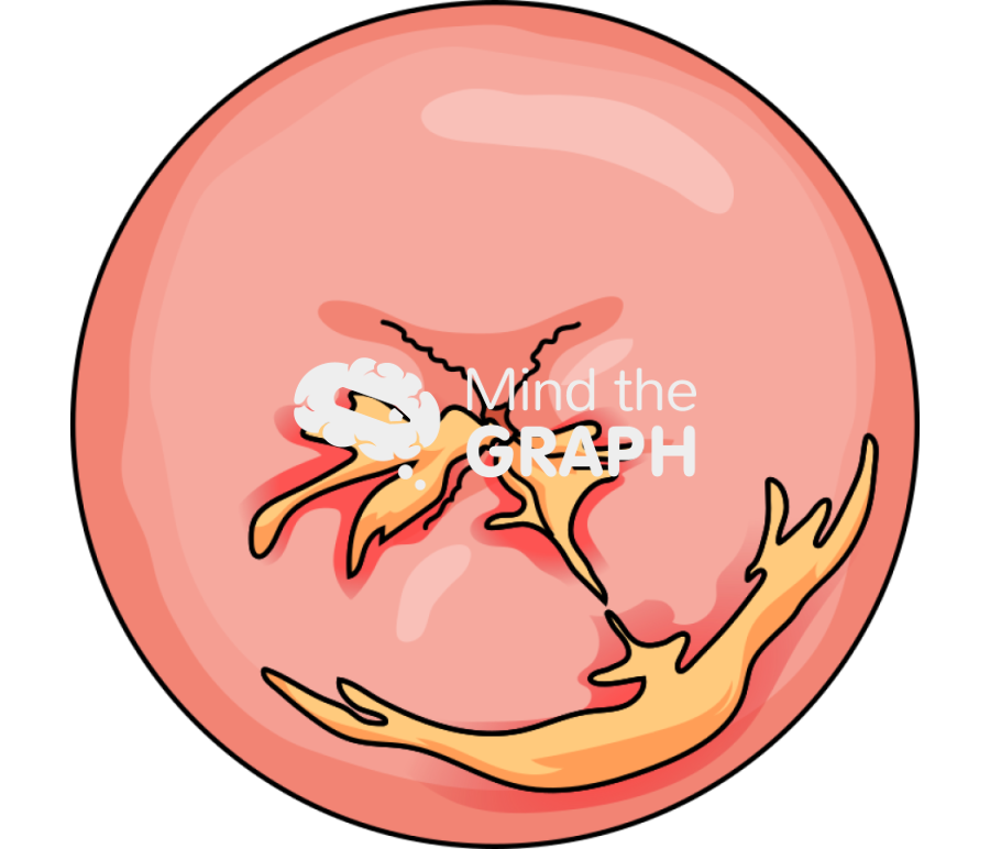 Cervix infection 3 Icons, Symbols, Pictures, and Images