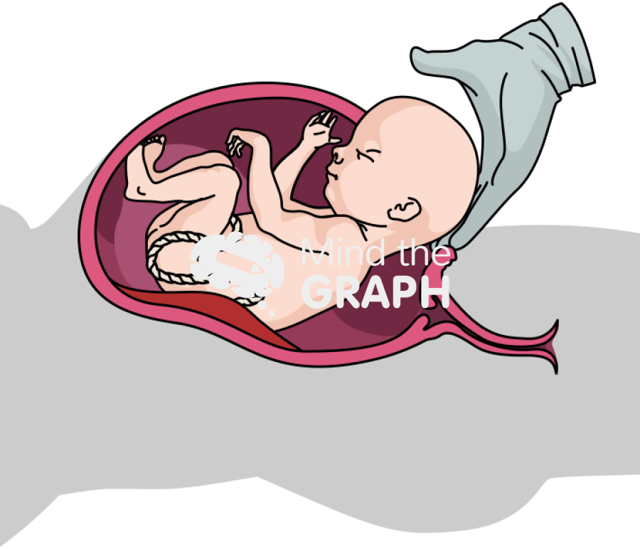 Cesarean section procedure lateral shape Icons, Symbols, Pictures, and Images