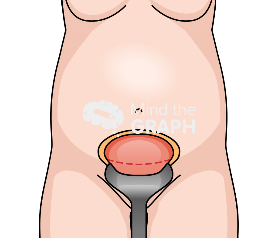 Cesarean section surgery front Icons, Symbols, Pictures, and Images